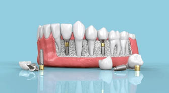 A Comprehensive Guide to Dental Implants